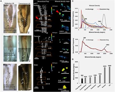 Insights Into Pulp Biomineralization in Human Teeth